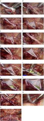 Obstacles and sustainability of enhanced recovery after surgery in pediatric laparoscopic pyeloplasty